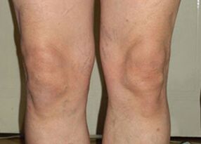 Despois dun tratamento con Osteflex, as articulacións volven á normalidade